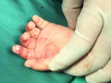 你相信嗎？兔子能把手指給咬斷了！