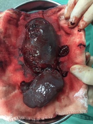 14歲男孩玩耍摔倒，脾臟破裂，險(xiǎn)些喪命！