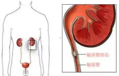 輸尿管結(jié)石，到底能不能保守治療？