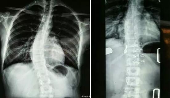 好好的脊柱怎么說(shuō)彎就彎了？你竟然都沒(méi)發(fā)現(xiàn)……