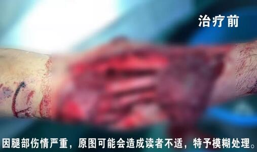 感謝安利醫(yī)院挽救了我的腿，沒有讓我落下殘疾……”