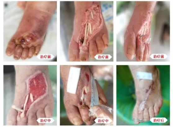 糖尿病并發(fā)癥有多可怕，及時(shí)治療糖尿病足避免截肢！
