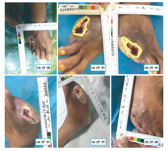 介入治療糖尿病足，您聽說過沒？