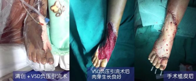 車禍猛如虎，救治如“華佗” ，手術(shù)＋康復(fù)，8歲小女孩車禍后日漸康復(fù)行走