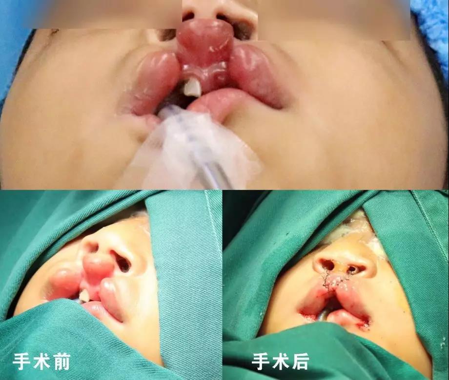 唇腭裂盡早治療消除孩子自卑心理，快樂成長！