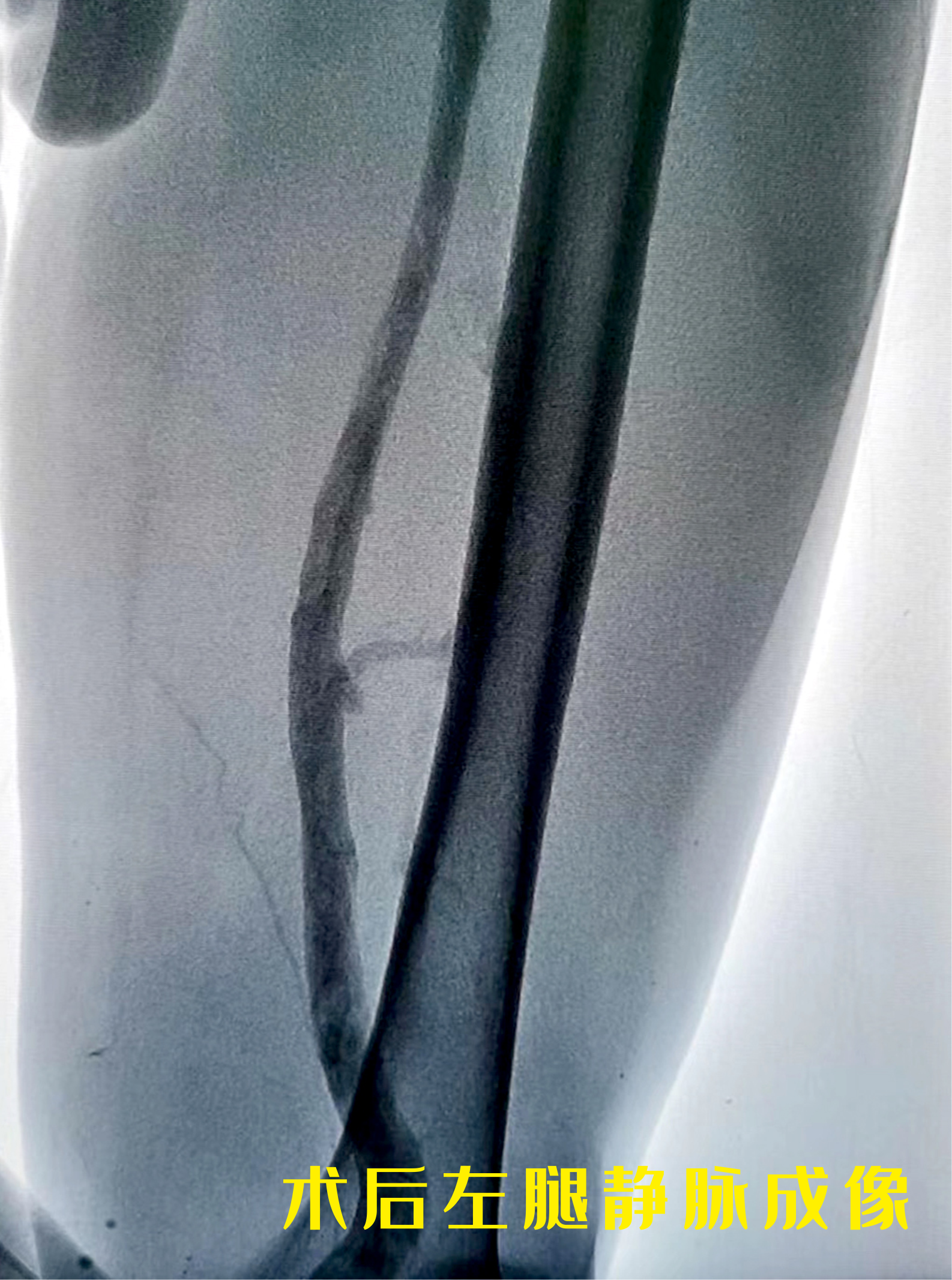 72歲老人，30年靜脈曲張，突發(fā)疼痛住院竟演變成了血栓！