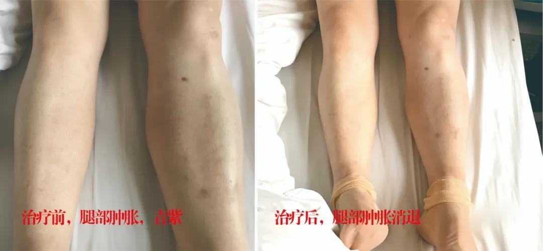 下肢靜脈血栓多年頑疾反復腫痛——疾病不容等待，早治療，早健康！