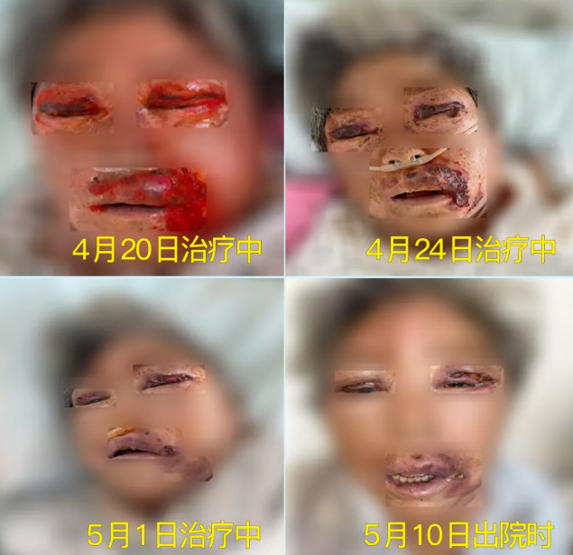 膿毒血癥（急性頜面部蜂窩組織炎）多學(xué)科聯(lián)合會(huì)診，幫助患者成功治愈！