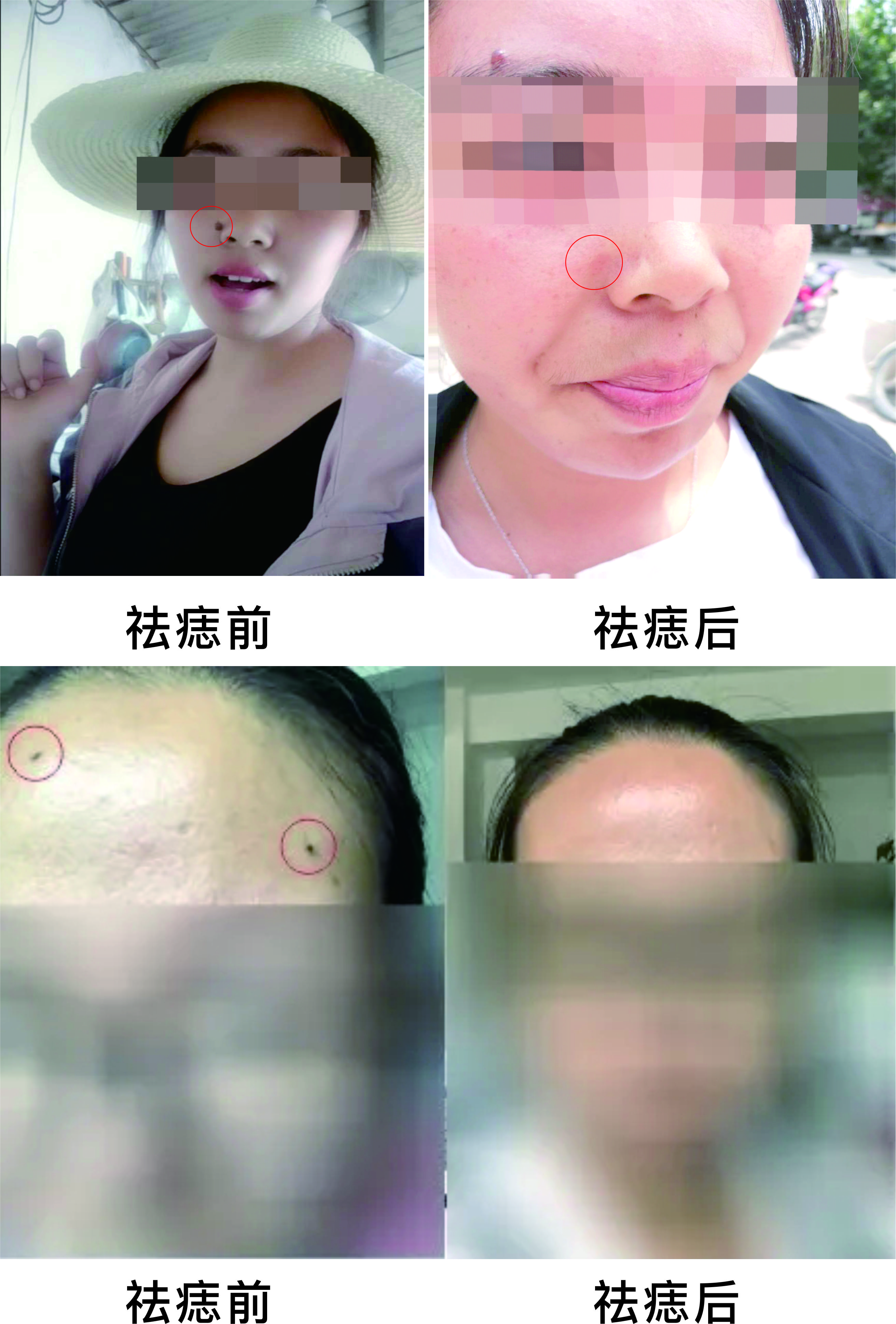 微波祛痣，告別臉部多余的“點綴”~