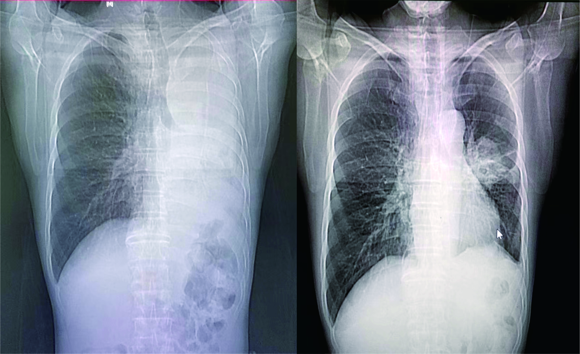 肺鱗癌IV期，首次化療一周期后胸部CT對(duì)比驚人！