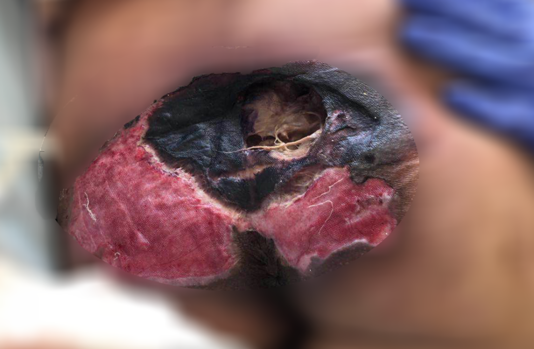 癱瘓3年的女患者臀部居然變成這樣?！