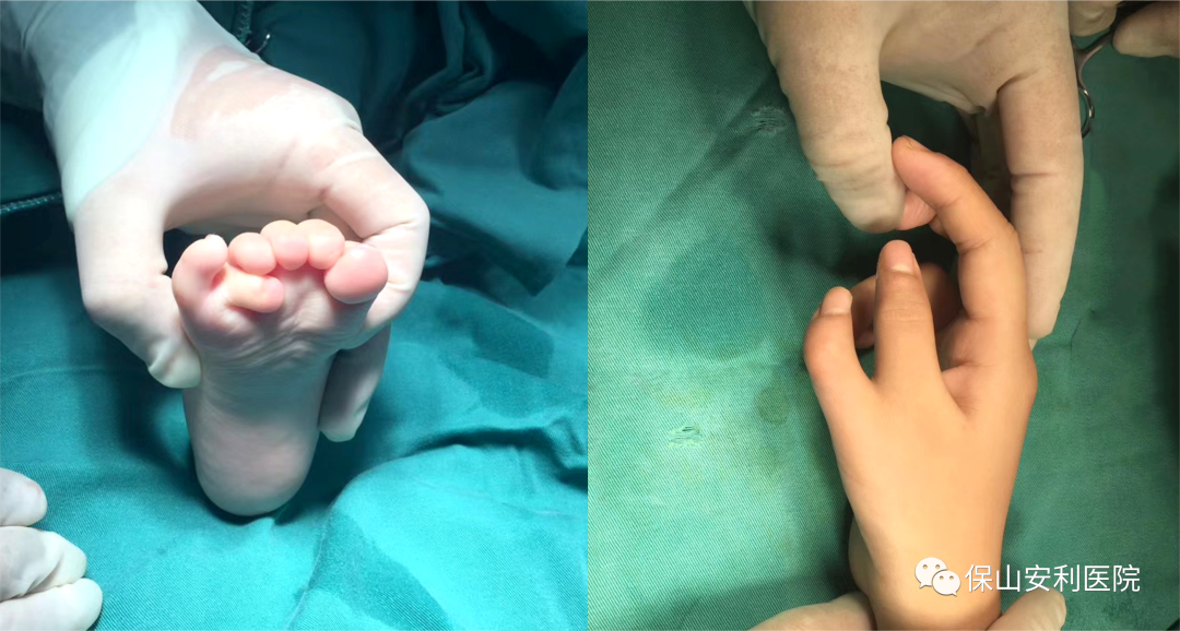 孩子先天手足多指（趾）不要慌，外二科幫你解除困擾！