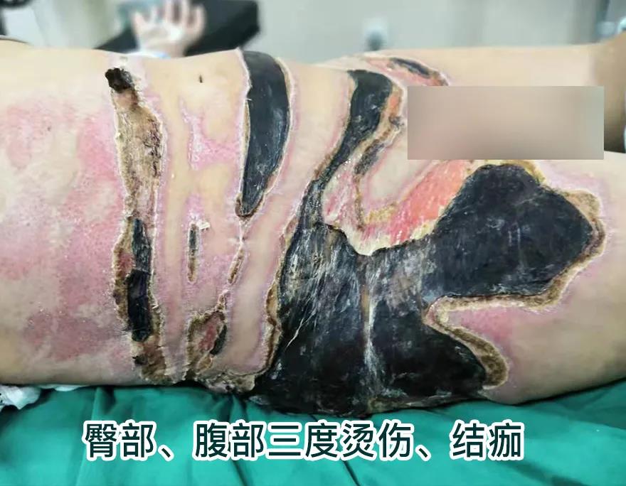 【保山安利醫(yī)院】80歲老人不慎燒傷，導致腹部、右側(cè)臀部大面積創(chuàng)傷，經(jīng)植皮治療創(chuàng)面逐漸愈合