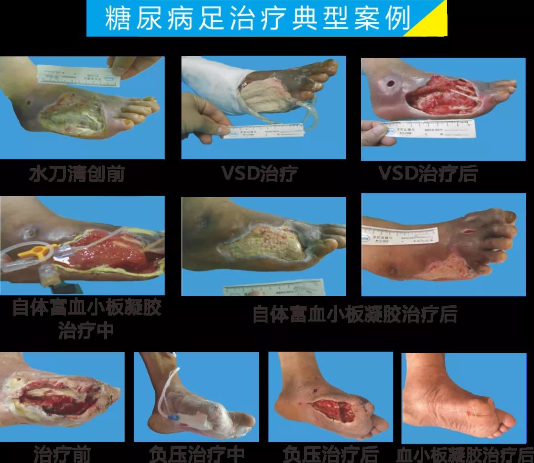 截肢、失明，甚至……，我們要做的是將糖尿病并發(fā)癥遏制在搖籃里！