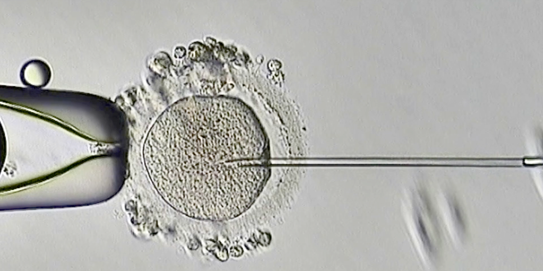 【喜訊】保山首例無(wú)精子癥通過(guò)試管嬰兒技術(shù)助孕成功！
