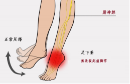 【保山安利醫(yī)院—健康科普】什么是足下垂！你了解嗎？