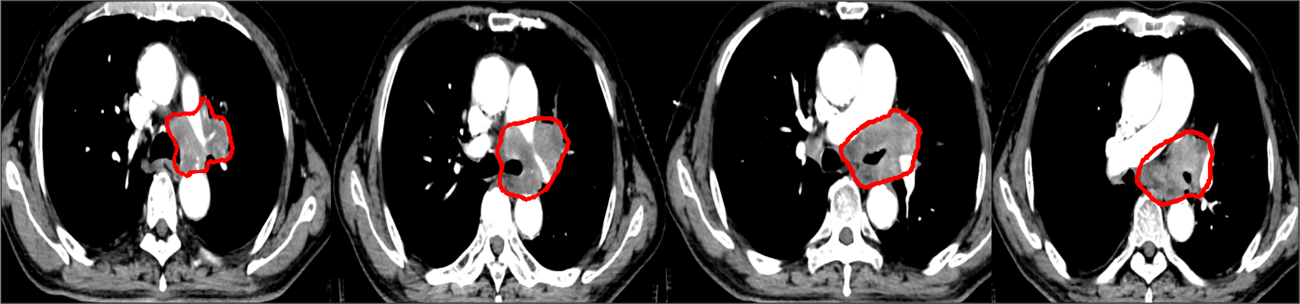 【保山安利醫(yī)院】對于局部晚期非小細(xì)胞肺癌患者，手術(shù)不能做，化療打不動，該怎么辦？