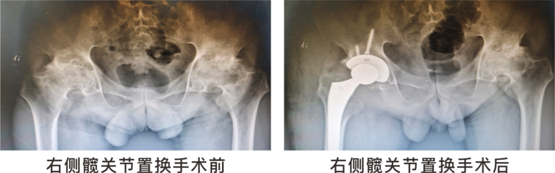 【保山安利醫(yī)院】長(zhǎng)期飲酒導(dǎo)致雙側(cè)股骨頭壞死，髖關(guān)節(jié)置換后重獲運(yùn)動(dòng)功能！