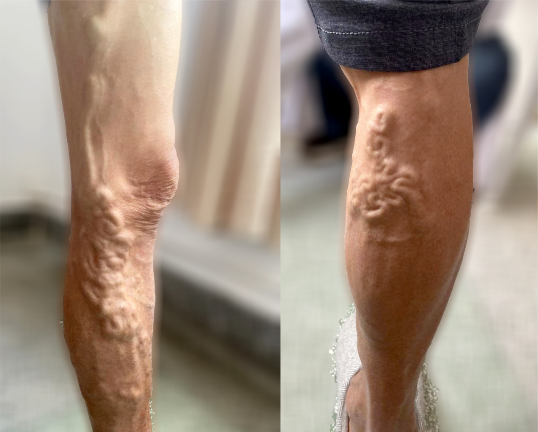 【保山安利醫(yī)院】大隱靜脈高位結扎＋剝脫術幫你解決大隱靜脈曲張“蚯蚓狀”紋路腿！