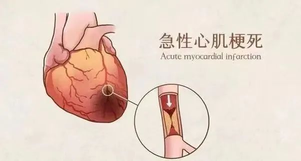 【保山安利醫(yī)院】11月20日“心梗救治日” 時(shí)間就是心肌，時(shí)間就是生命！