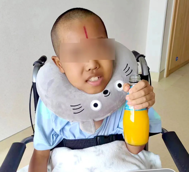 10歲腦干膠質(zhì)瘤患兒經(jīng)23次放療后病情明顯好轉(zhuǎn)