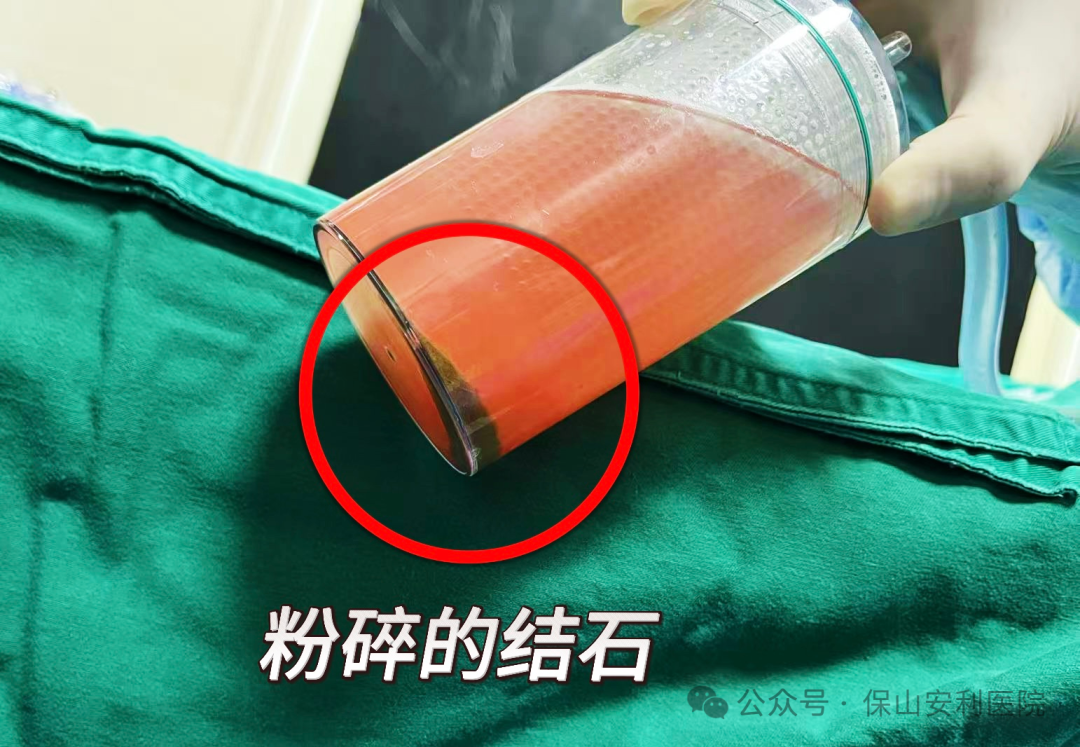科普丨泌尿結(jié)石“克星”鈥激光碎石術(shù)，手術(shù)動(dòng)圖揭秘全過(guò)程！